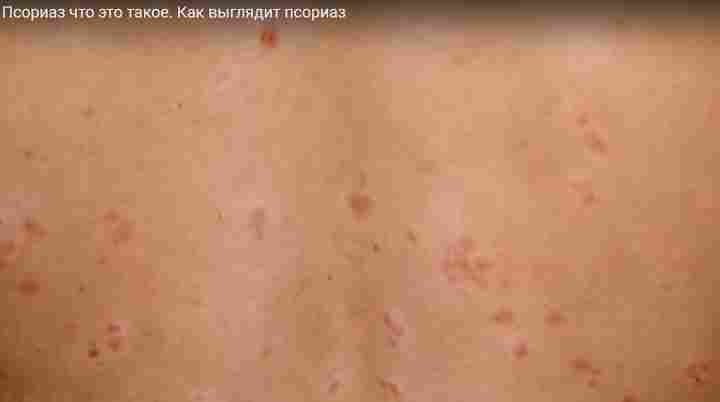 Что такое псориаз Что такое псориаз