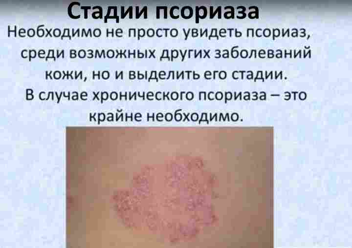 Стадии псориаза Стадии псориаза